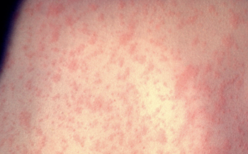 9,351 contagios de sarampión en México. Alerta en el país