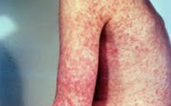 151 contagios de sarampión en las últimas 48 horas. Suman ya 1,487 casos